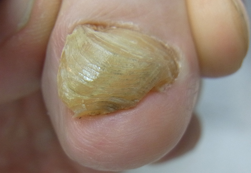 埼玉巻き爪矯正院 肥厚爪