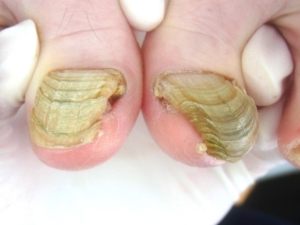 爪甲鉤彎症の症例写真