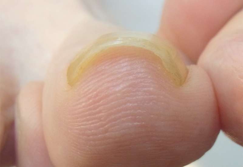 埼玉巻き爪矯正院の(軽度)の参考例