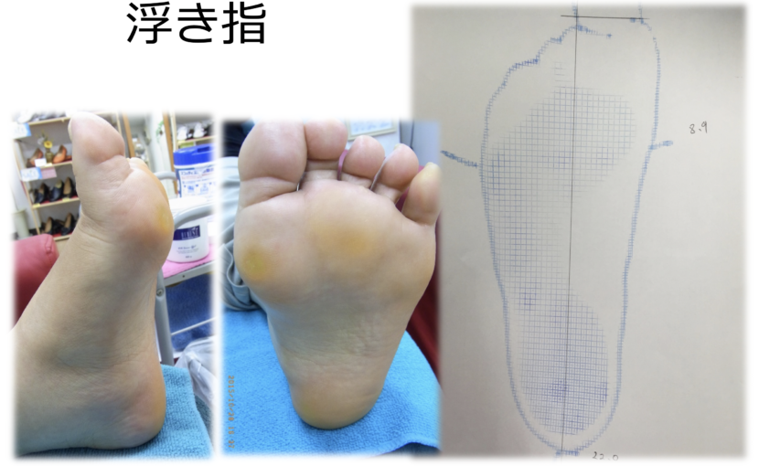 巻き爪と浮き指の関係 埼玉巻き爪矯正院大宮院