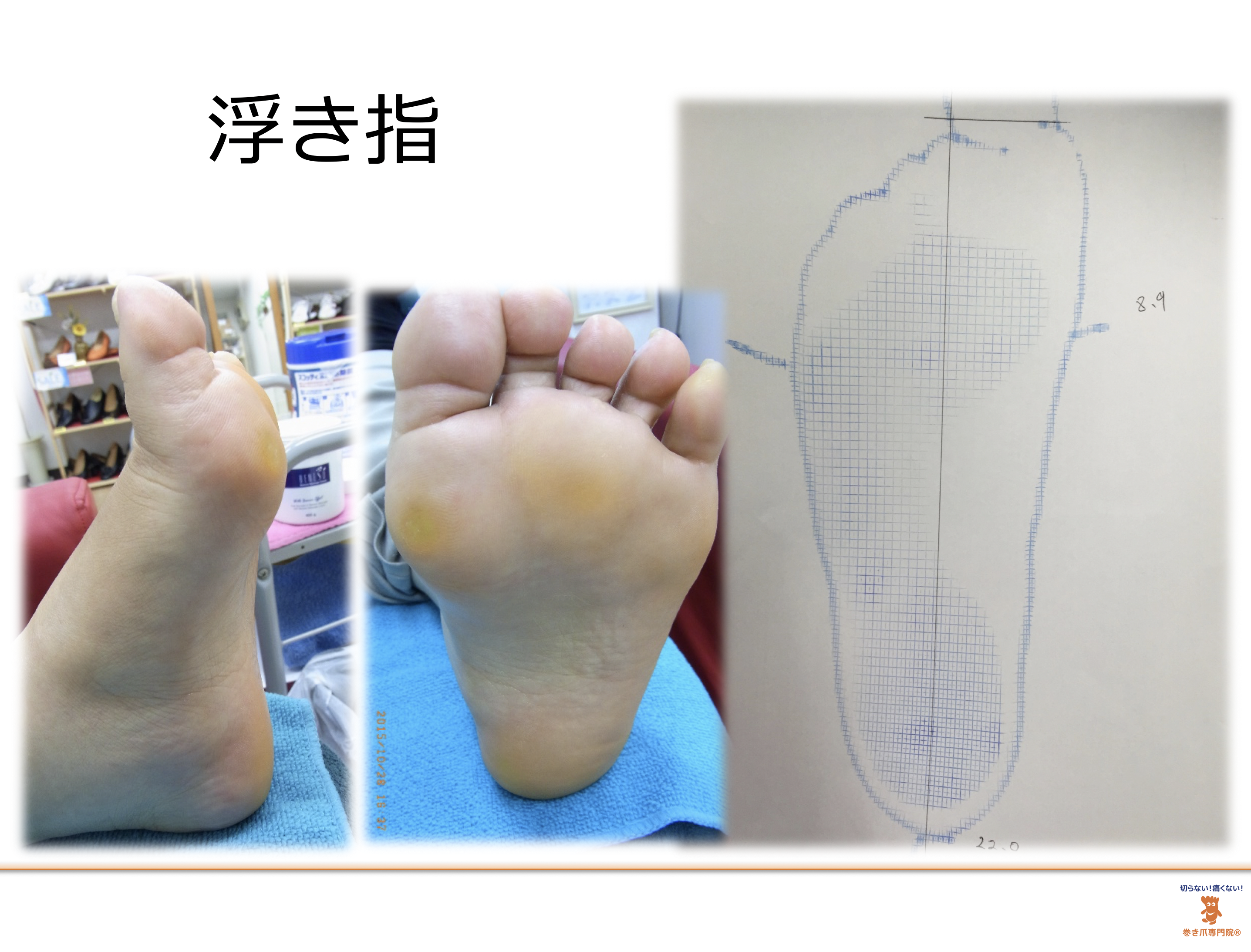 巻き爪と浮き指の関係　埼玉巻き爪矯正院大宮院