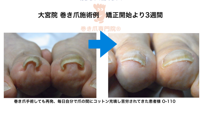 埼玉巻き爪矯正院 大宮院施術例 O-110