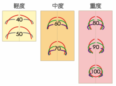 巻き爪の角度