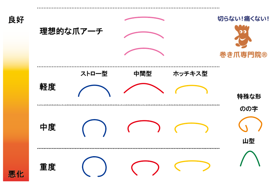 巻き爪程度判断の目安表