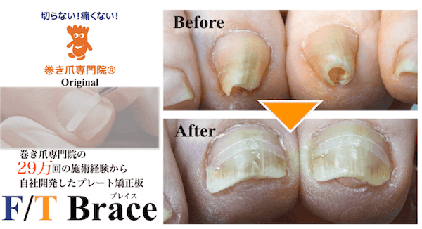 巻き爪専門院の開発したF-Tブレイス