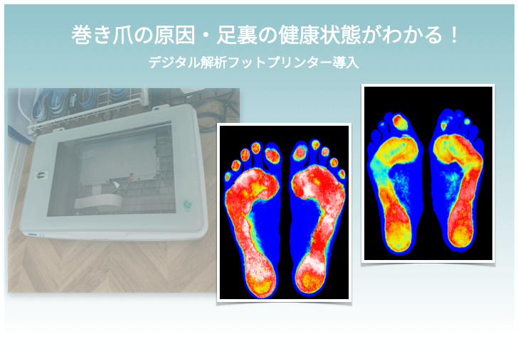 足裏の健康状態がわかるデジタルフットプリンター導入 | 巻き爪矯正院 