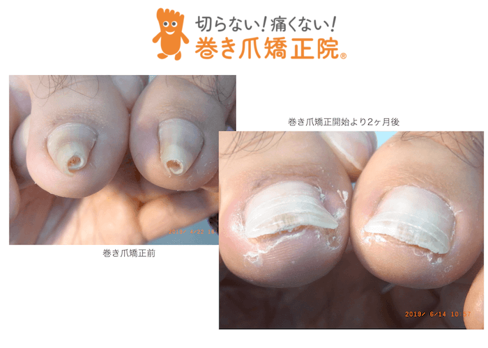 巻き爪重度矯正症例