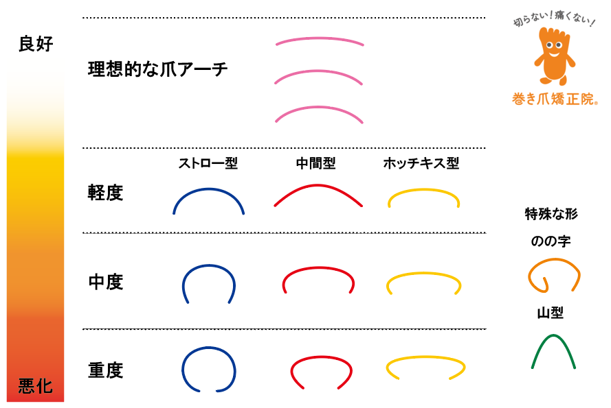巻き爪程度表