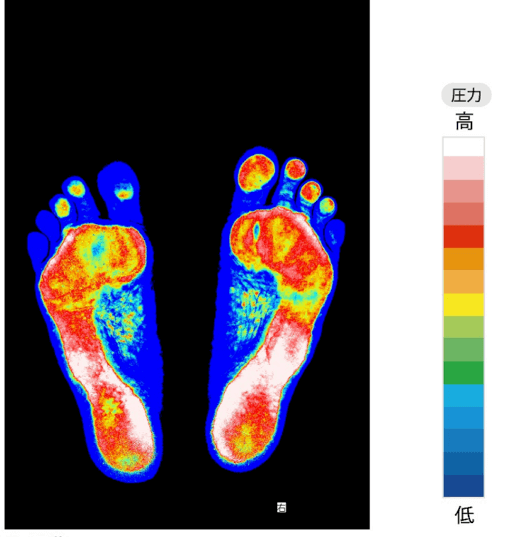 巻き爪の原因の浮指 フットプリント 足裏バランス測定器