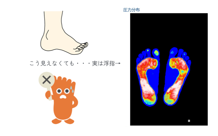 巻き爪の原因は浮指は見た目ではわからない!巻き爪先生解説