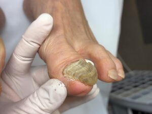 埼玉巻き爪矯正院　爪甲鉤彎症　厚くなる爪の症例写真　