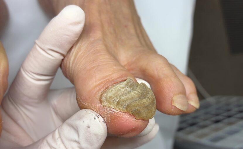 埼玉巻き爪矯正院　爪甲鉤彎症　厚くなる爪の症例写真　